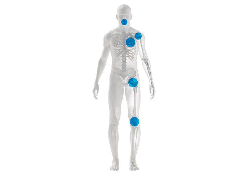 Transparent visualization of a human body with highlighted joint and implant areas in the shoulder, hip, knee, and arm.