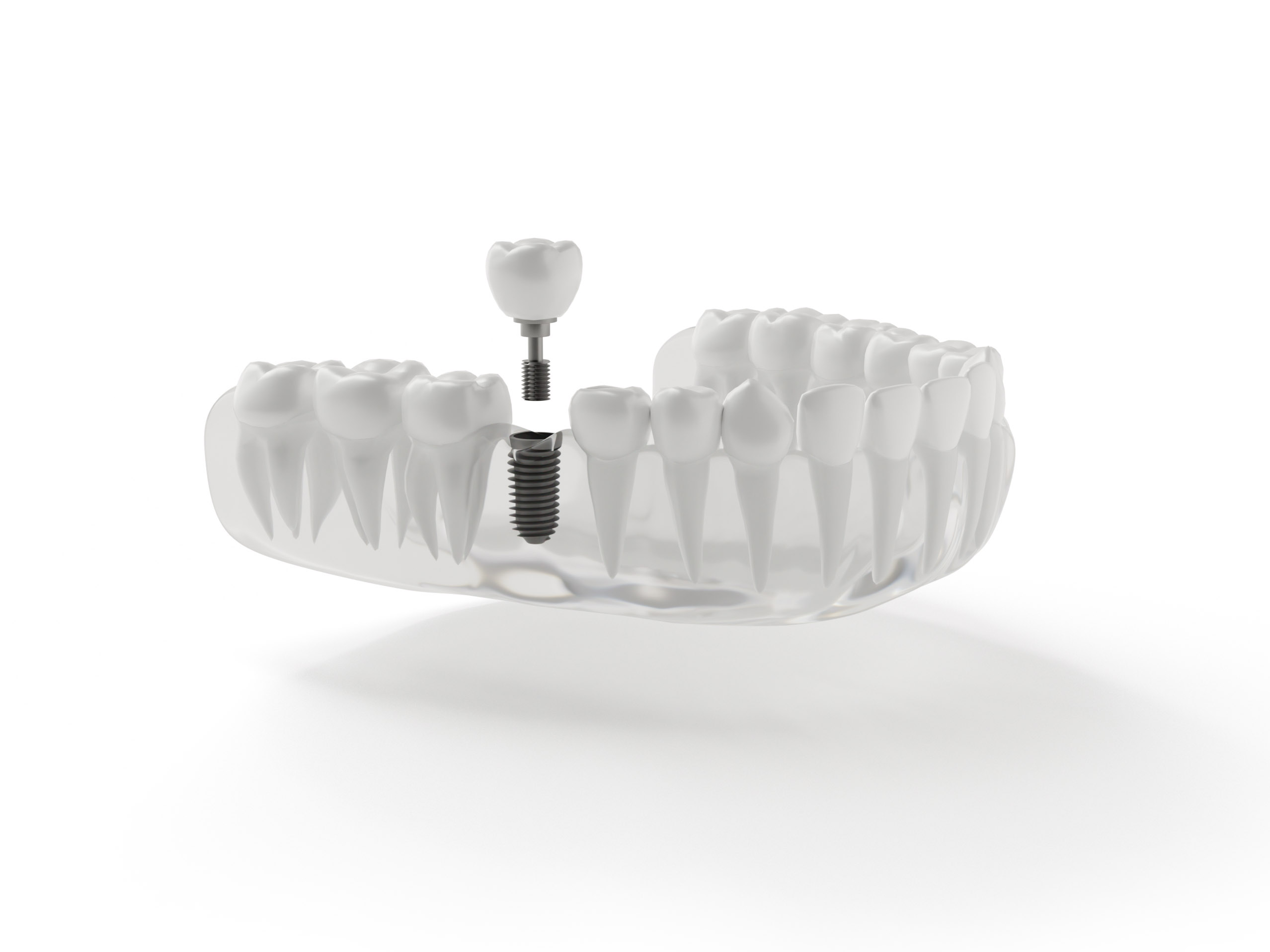 3D rendering of a dental implant with inserted screw and crown within a human jaw model.