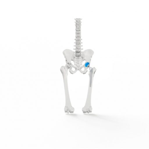 3D rendering of the human pelvis and spine with a highlighted hip implant on the right side.
